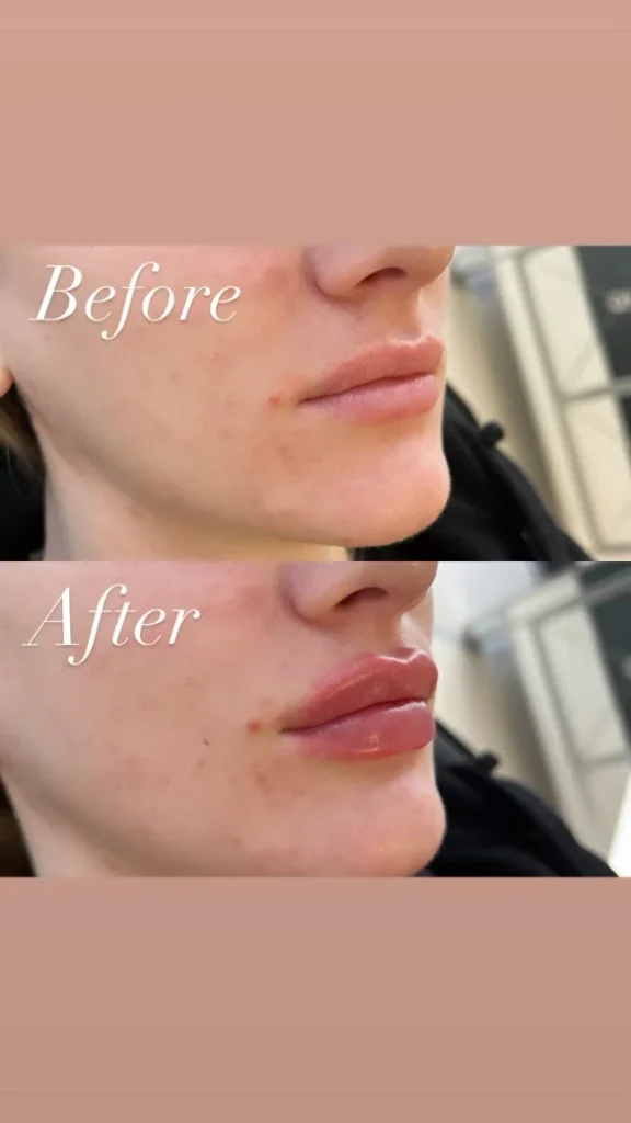 Lip fillers Before and After Englewood CO