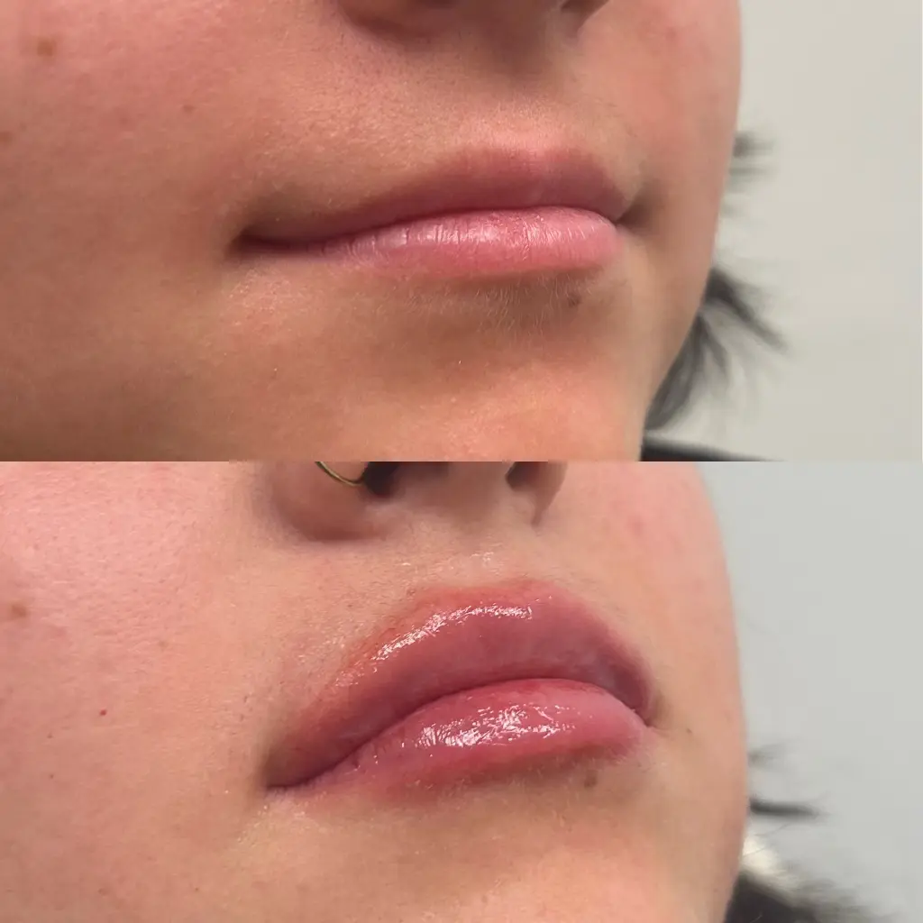 Lip fillers BAs Health and beauty med spa Englewood CO