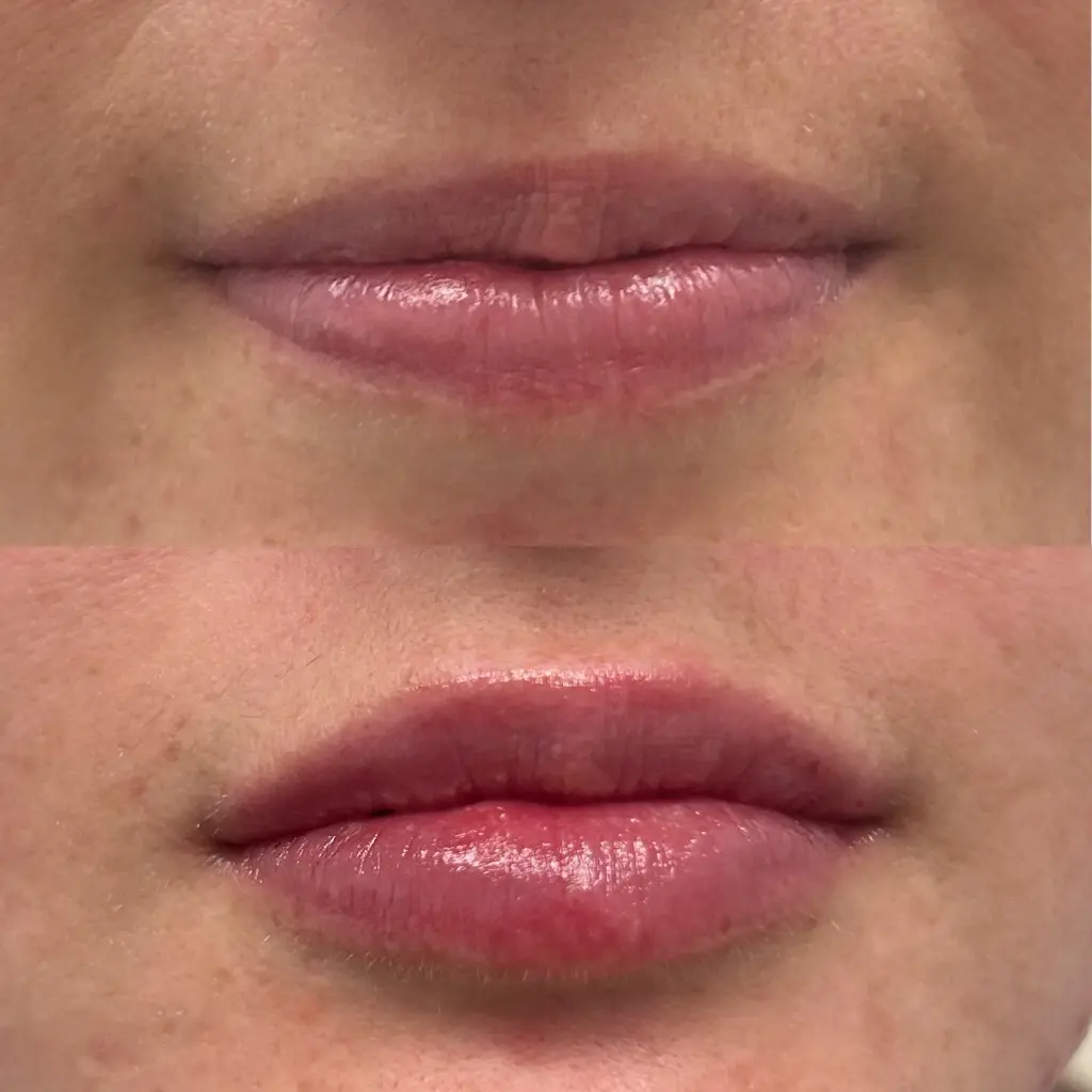 Lip Filler