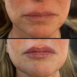 Lip Filler