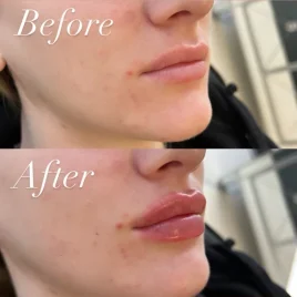 Lip fillers Before and After Englewood CO