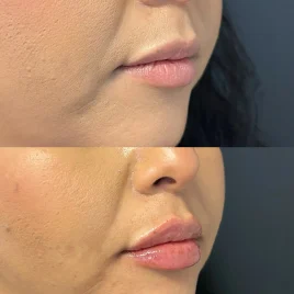 Lip Filler