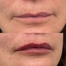 Lip Filler