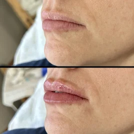 Lip Filler