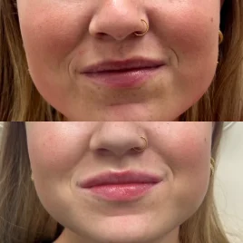 Lip fillers Med spa Englewood CO