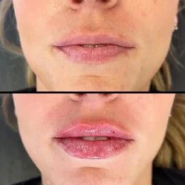 Lip Filler