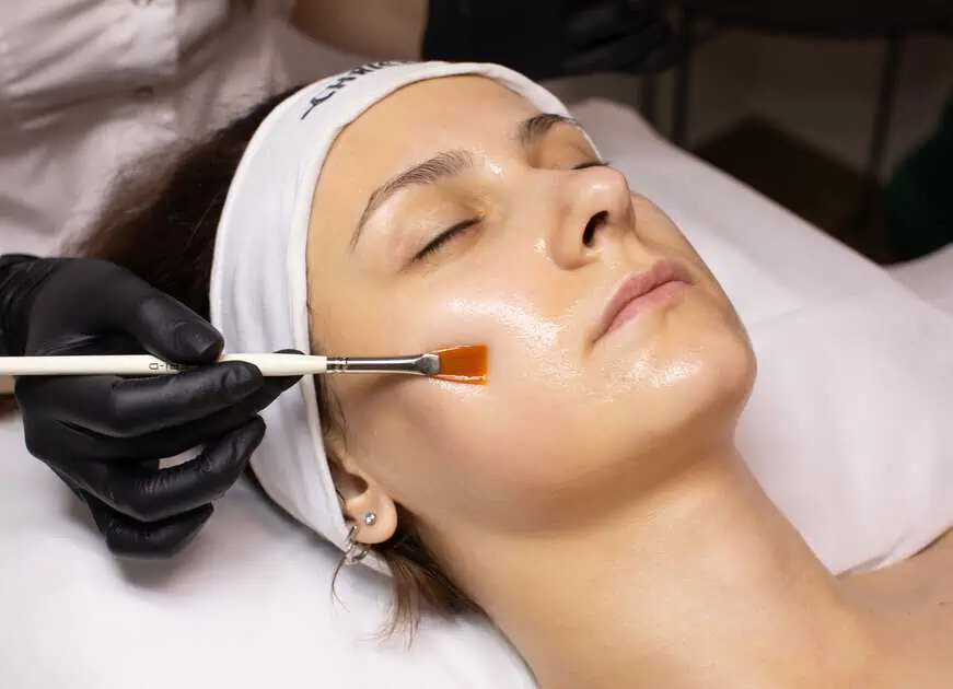 Chemical Peels Treatment in Parker & Englewood CO by The Honey Dipped Injector